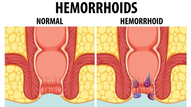 Haemorrhoids: What They Are, Causes, and Symptoms