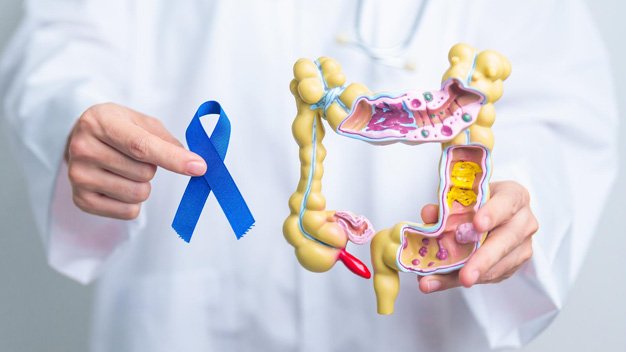 Colon Cancer: The Importance of Screening, Symptoms, and Effec...